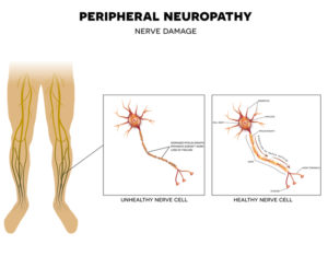 polyneuropathie