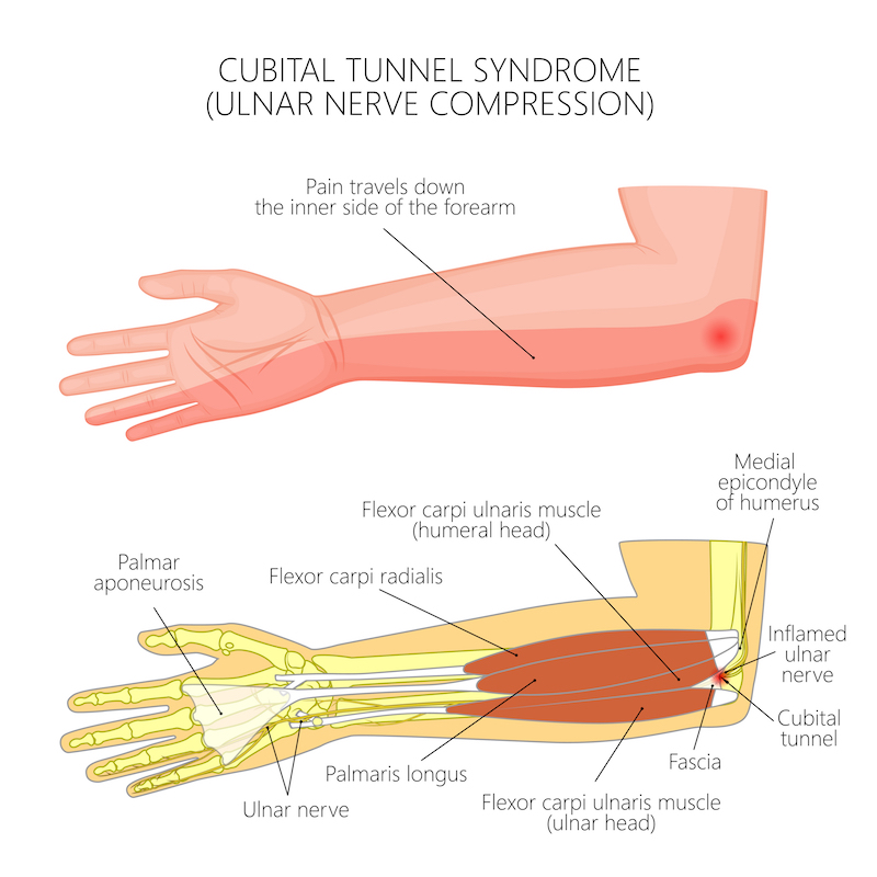 Sulcus ulnaris Syndrom